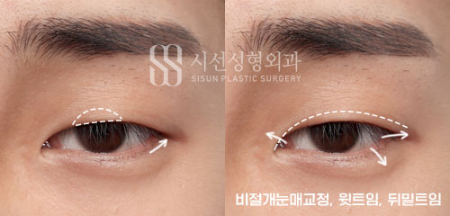 남자 눈매 교정술