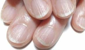 창백한 손톱이 보내는 몸속 경고