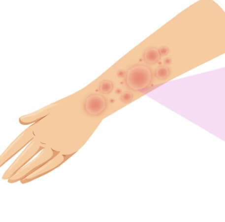 볼거리(유행성이하신염)입니다.