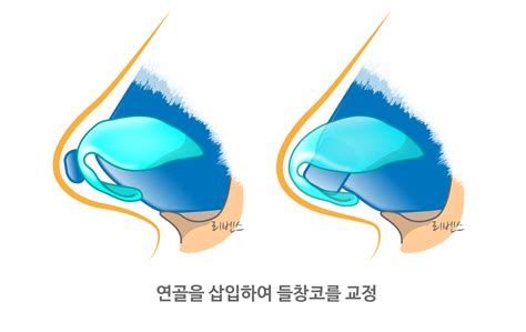 비중격만곡증수술