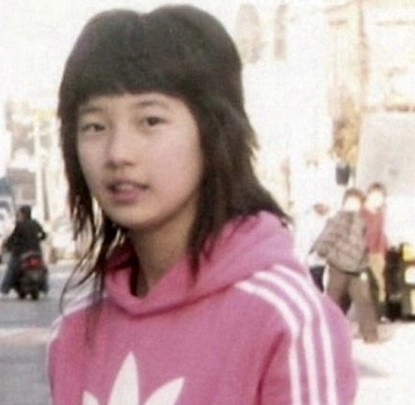 임플란트 후 교정 김태희 수지 효과 