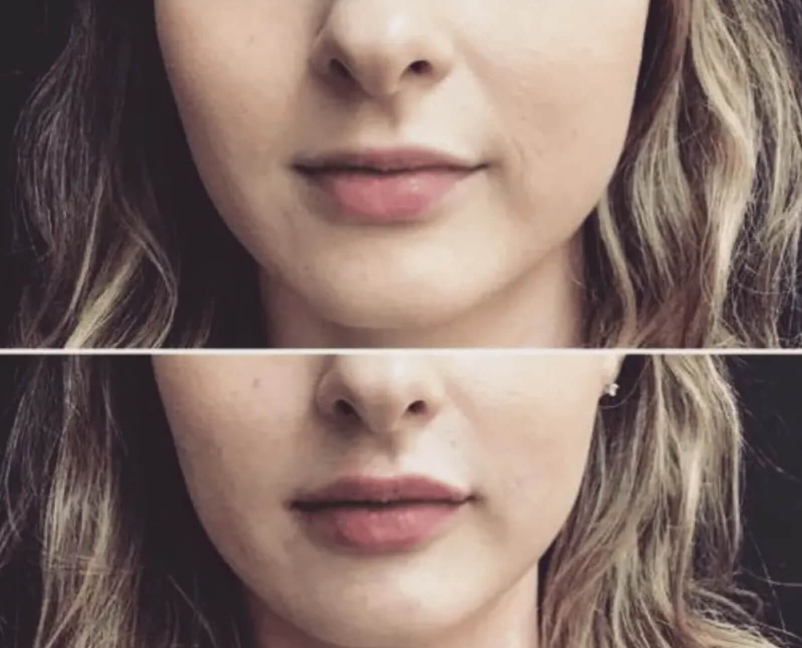 팔자주름 필러 효과