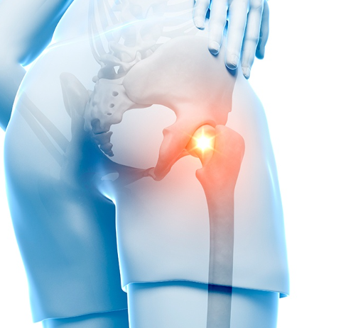 좌골신경통의 진단