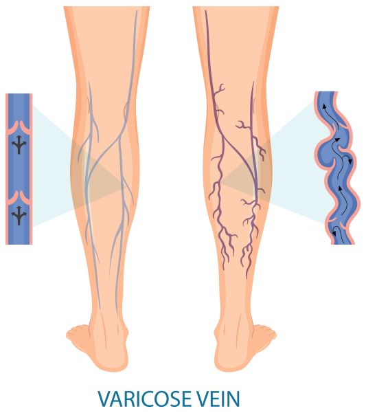 human-legs-with-varicose-vein