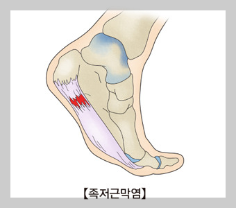 족저근막염