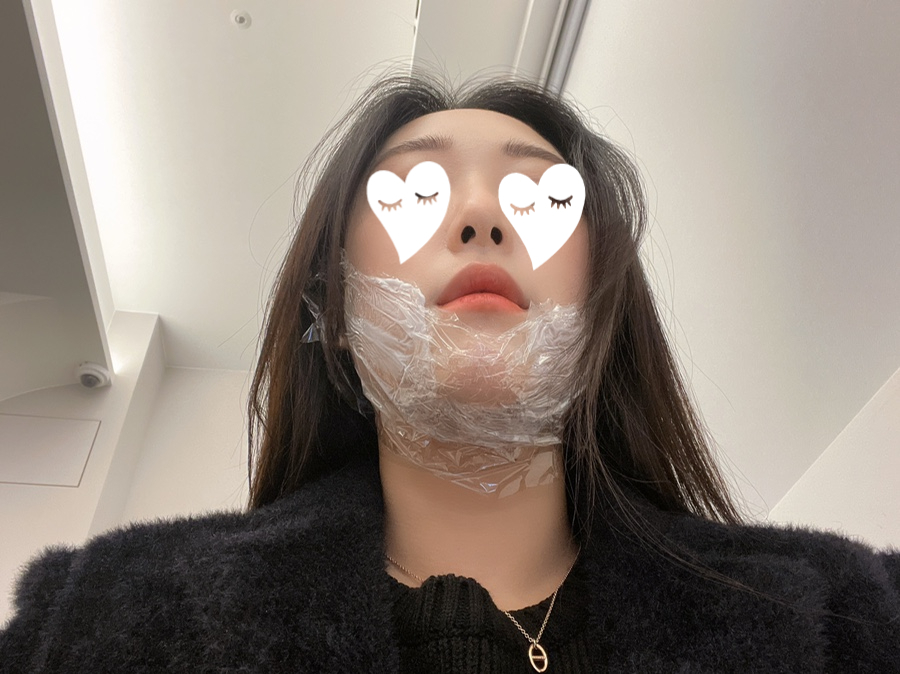 이중턱 보톡스 후기