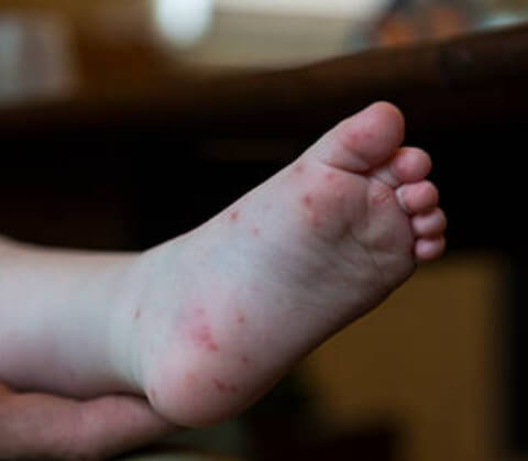 수족구 증상이 발에 나타남