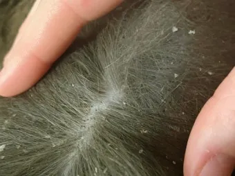 고양이 비듬 원인, 치료, 제거법_29