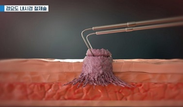 경요도내시경절제술