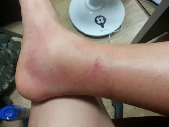 쇠파리에 물리면 증상 대처법과 응급처치 방법 안내_16