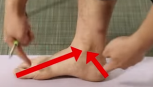 무지외반증 초간단 치료법&amp;#44; 무지외반증 교정기