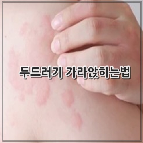두드러기 가라앉히는법