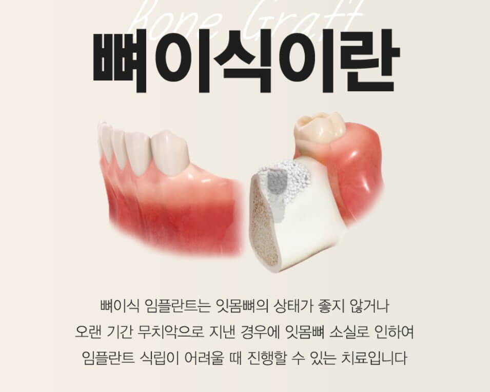 뼈 이식