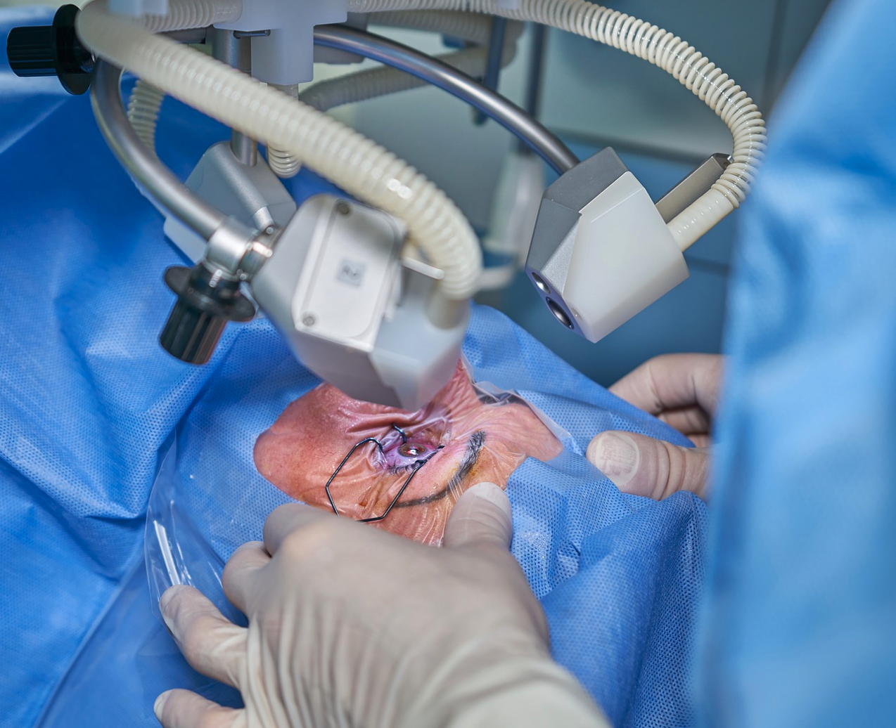 백내장 초기증상 수술비 정부지원 원인 증상 부작용