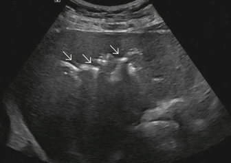 담도기종 (Pneumobilia)