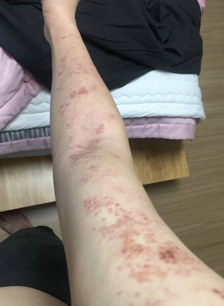 대상포진