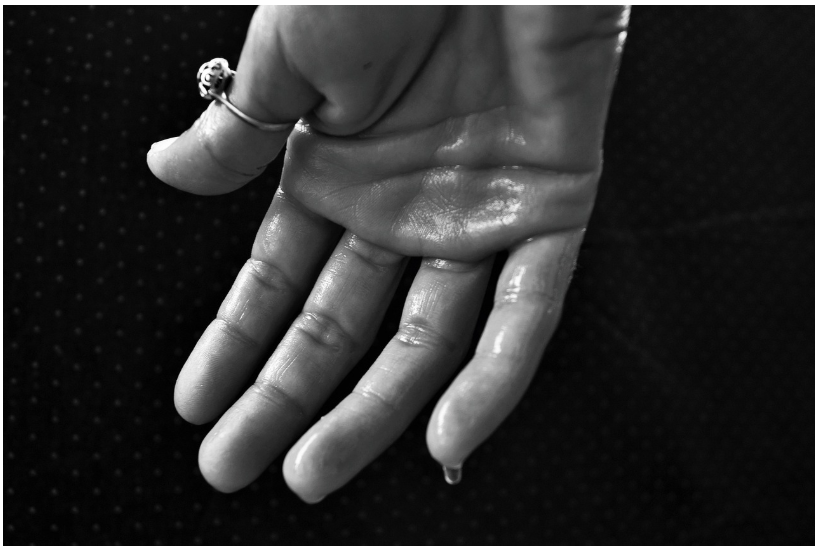 땀이 멈추지 않는 이유, 다한증 완전 정복 가이드