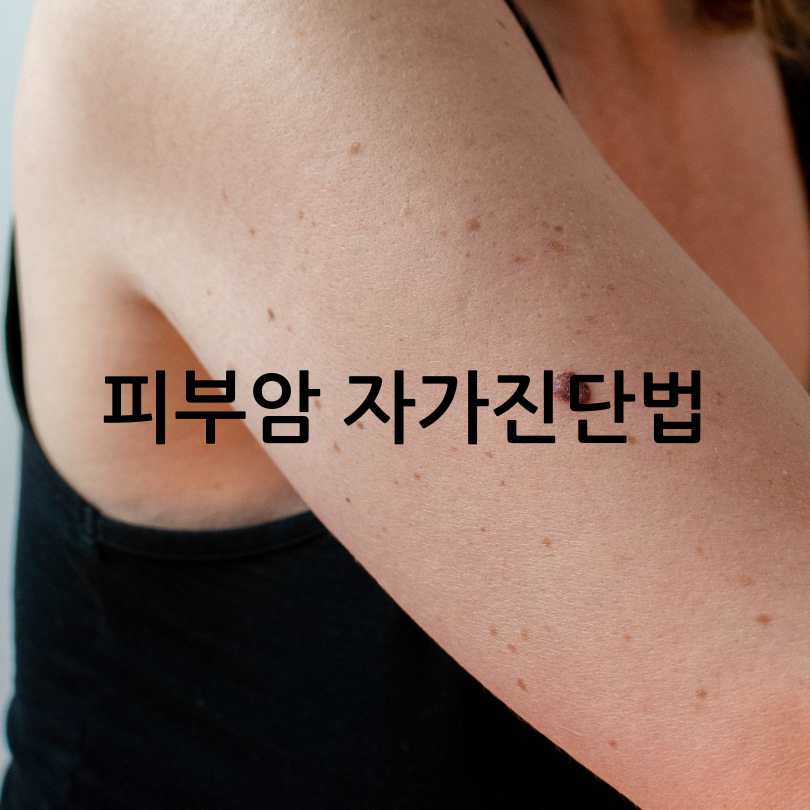 피부암 자가진단법&amp;#44; 피부암 점모양과 초기증상