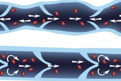 하지정맥류 증상&amp;#44; 수술비용&amp;#44; 도움이 되는 운동