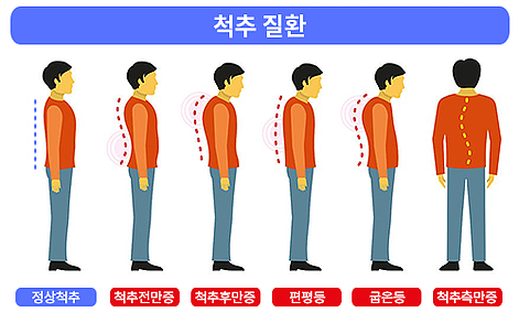 척추질환