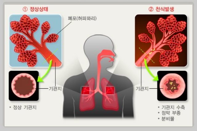 일반 천식과 기침형 천식의 차이점 천식 완화에 도움이 되는 음식 7가지