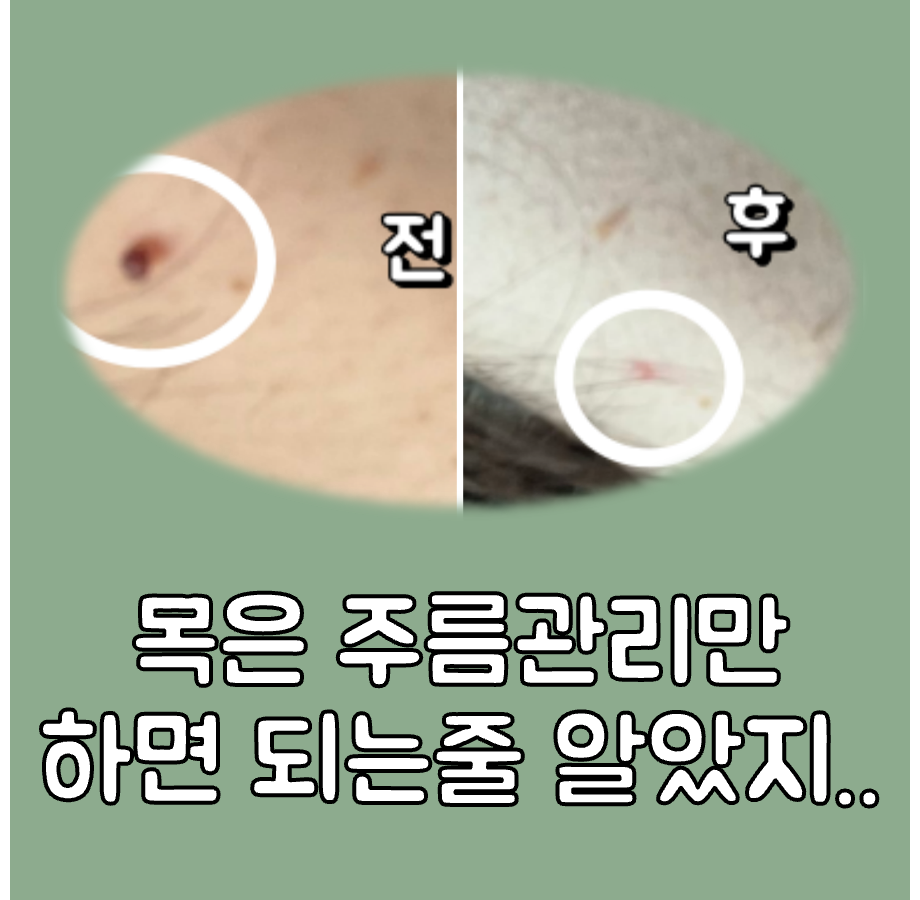 쥐젖, 목주름 관리 대표이미지