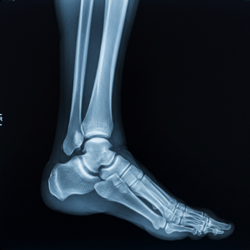 복숭아뼈 통증 완화하는 방법14