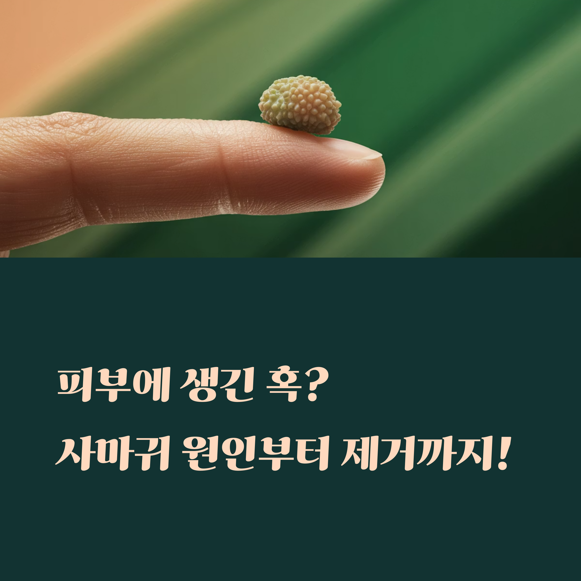 손가락 위에 사마귀로 추정되는 혹이 올라간 모습을 클로즈업으로 보여주는 이미지, 사마귀 원인과 제거에 대한 안내를 암시함