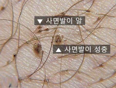 사면발이