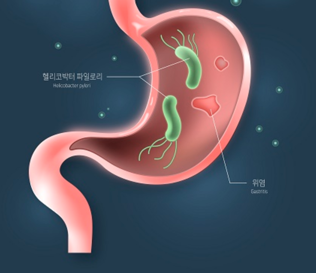 헬리코박터균 4