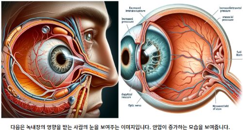 녹내장의-영향을 받는-사람의-눈을 보여주는-이미지입니다.-안압이-증가하는-모습을-보여줍니다.