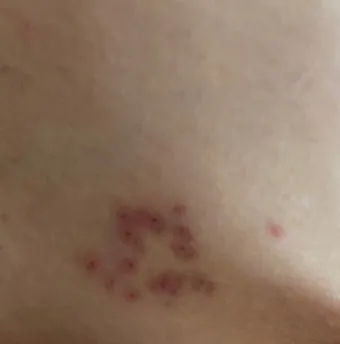 대상포진 감염 증상 부위 손 허리 허벅지_22