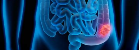 대장암 초기증상1