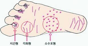 무좀
