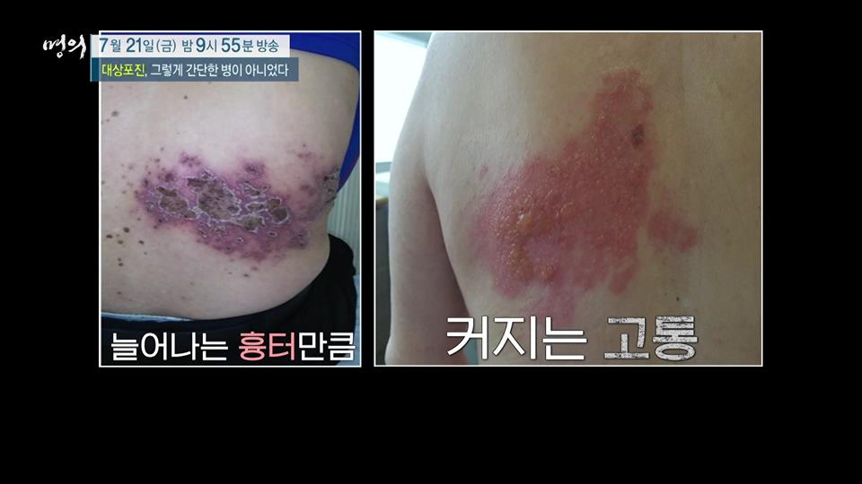 대상포진 후 신경통, 합병증, 이명, 시력 저하 치료 방법 마취통증의학과 전문의 최상식, 김재헌 교수 예약 추천