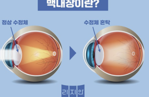 백내장 원인과 치료방법