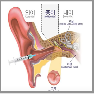 돌발성난청치료