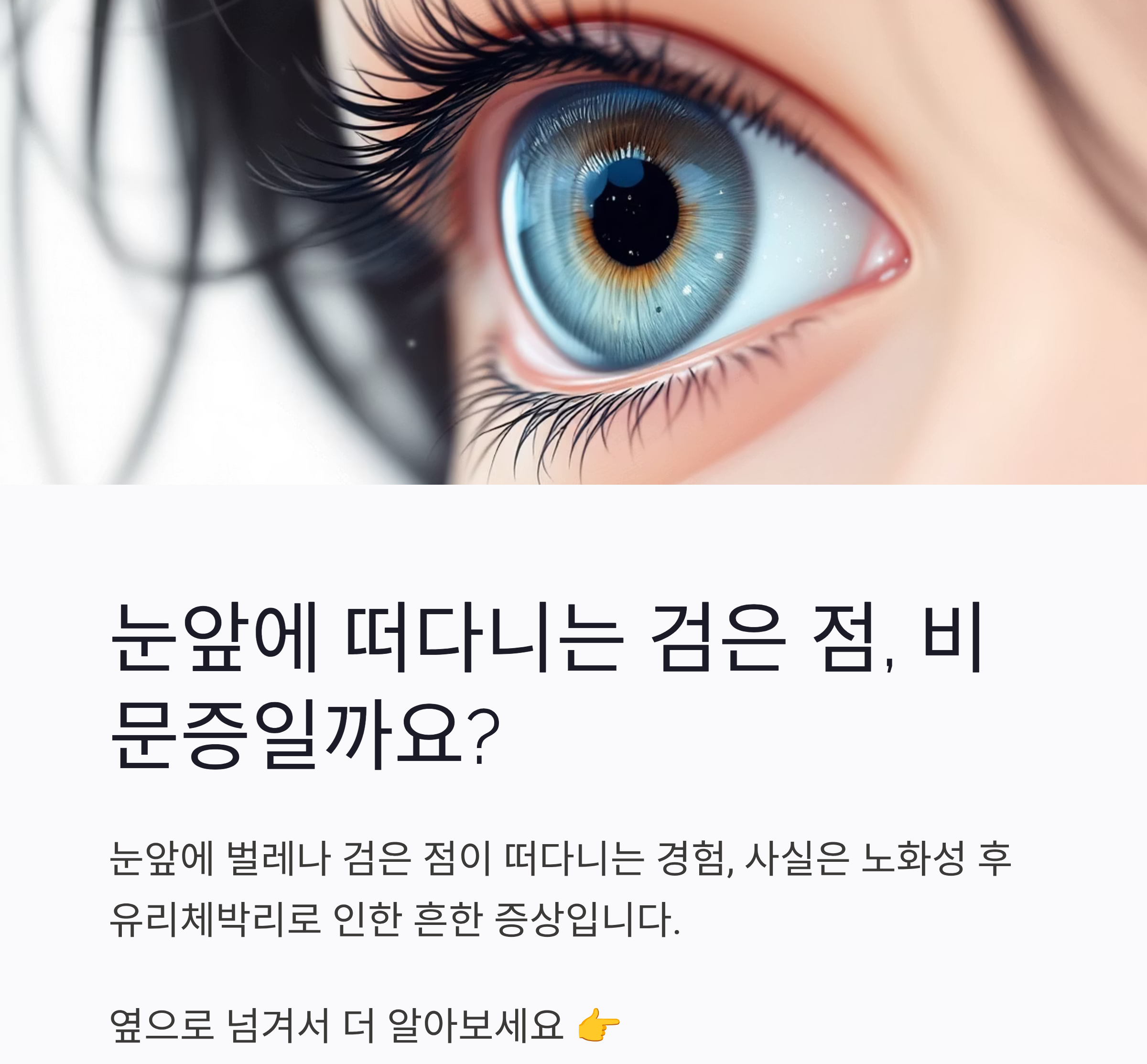 (노화성 후유리체박리)