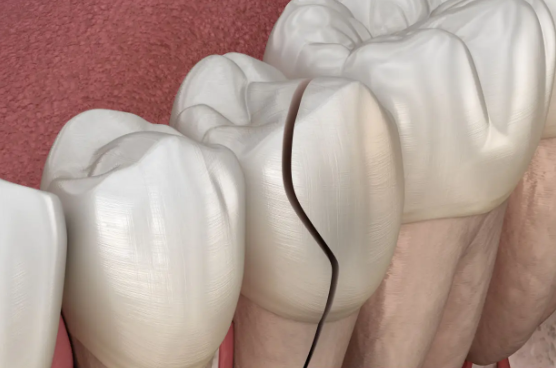 크랙 치아의 원인과 증상, 치료 방법을 알아보자