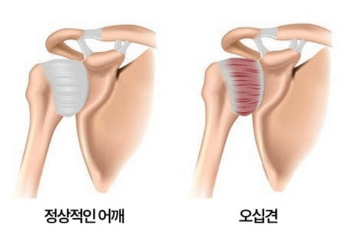 오십견 어깨