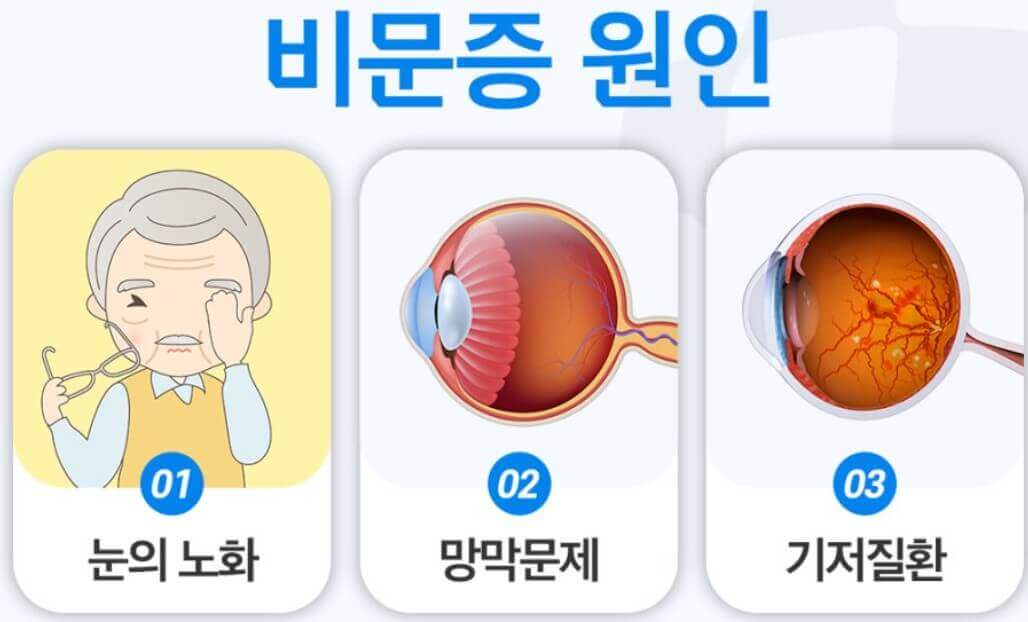 유리체 현상 설명하는 사진