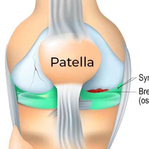무릎 연골주사 가격 및 종류, 부작용 가이드