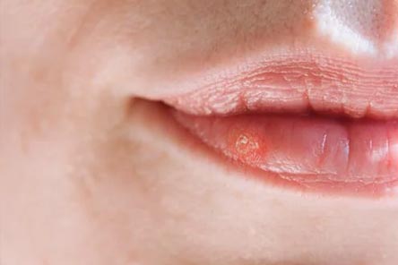 입술포진-이미지