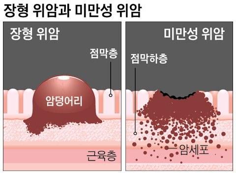 4기 위암의 생존율