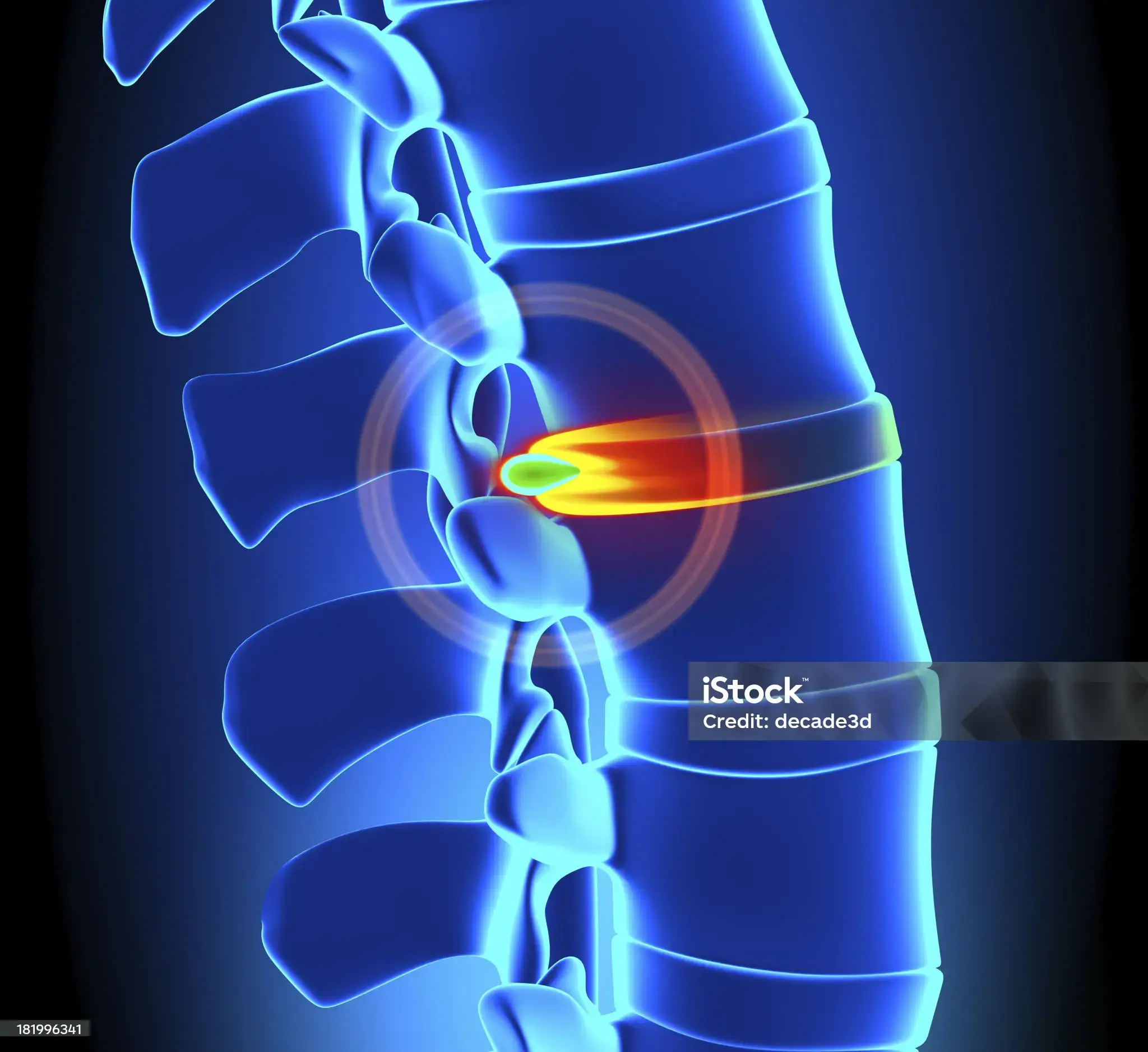 허리 디스크 초기 증상