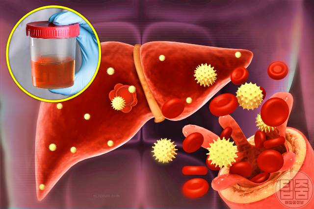 a형간염 증상 원인 소변색깔 갈색