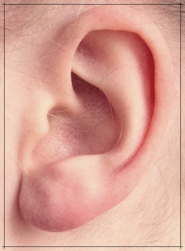 고막찢어지면 증상과 치료 방법들