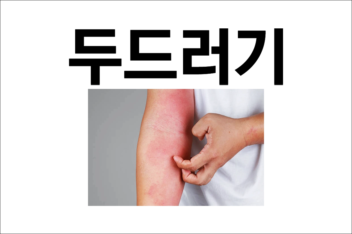 두드러기 원인 증상 종류 치료 예방