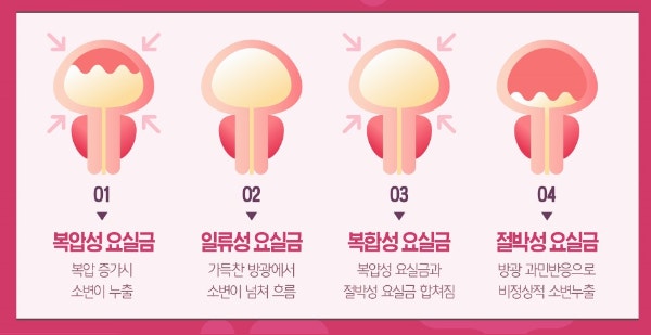 중년 요실금의 원인 및 증상, 치료방법