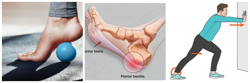 족저근막염 관련 사진 3개